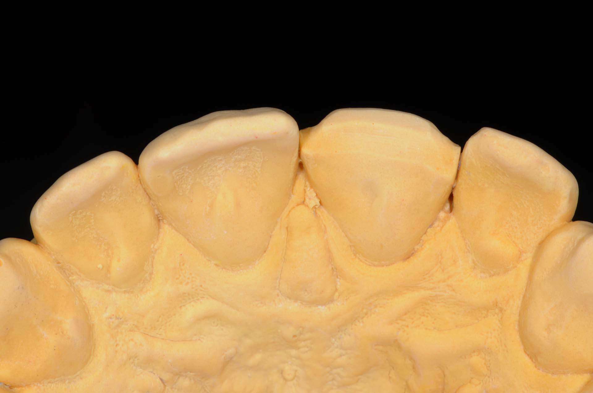 Veneer 21